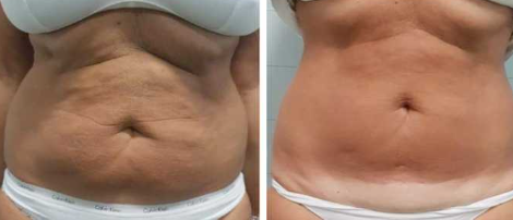 SVELTEA - Masseur Anti-Cellulite